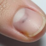 czerniak paznokcia zdjęcie pokazujące ciemne przebarwienie pod płytką paznokciową
